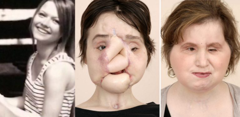 How Faith Helped America’s Youngest Face Transplant Recipient Want to Live Again