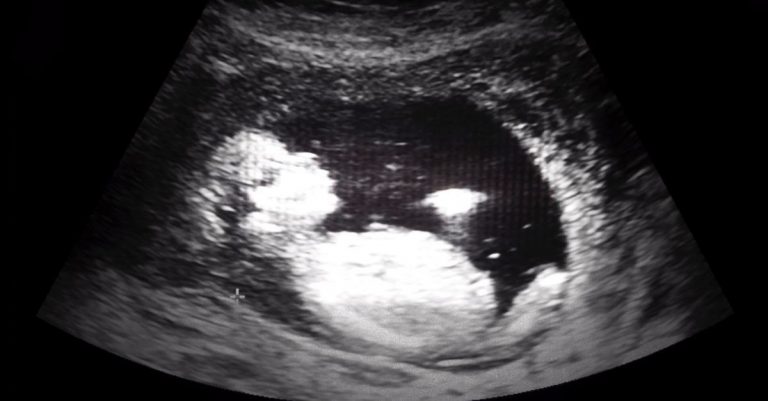 StemExpress CEO Admits to Trafficking Baby Body Parts, Including Intact Heads, Beating Hearts